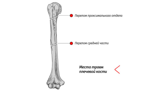 Перелом плечевой кости