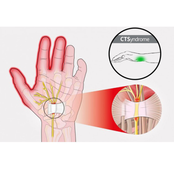 Система запястных туннелей - CTSyndrome