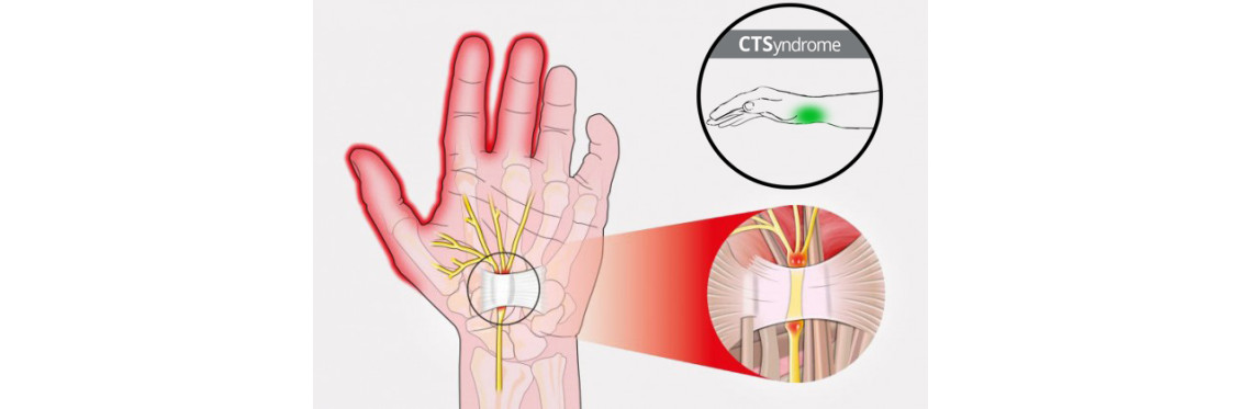 Синдром запястного канала