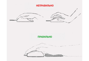  СИНДРОМ КАРПАЛЬНОГО ТУННЕЛЯ