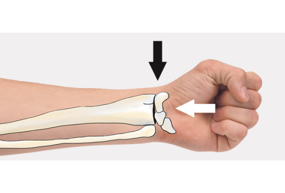 Действие сил на дистальный лучелоктевой сустав