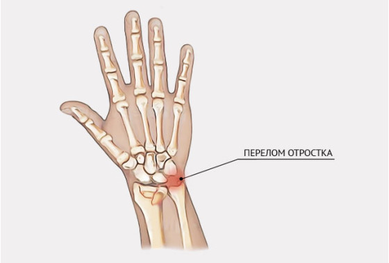 Перелом локтевого отростка