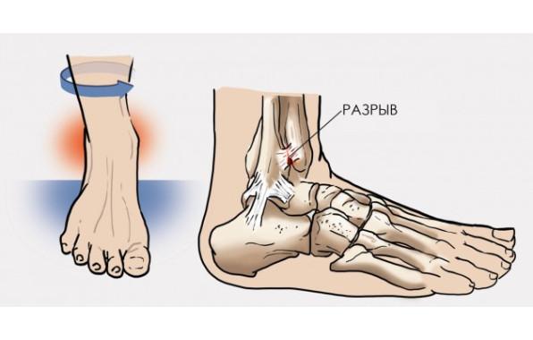 ВЕРХНИЙ ВЫВИХ ЛОДЫЖКИ