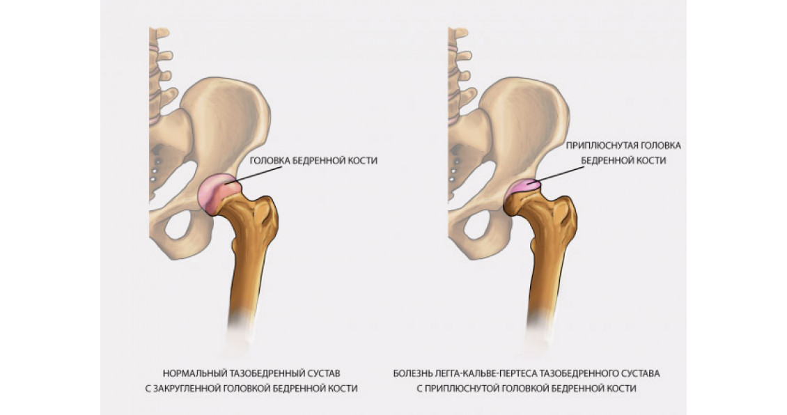 Сустав бедренной кости. Грибовидная деформация головки бедренной кости. Туннелизация шейки бедра. Корсет для бедренной кости.