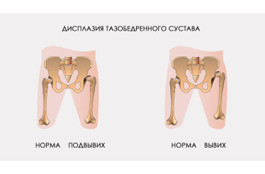 Дисплазия и вывих тазобедренного сустава