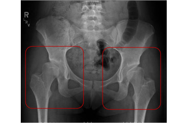 Здоровые тазобедренные суставы женщины преклонного возраста
