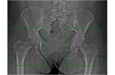 Двухсторонняя дисплазия у 29-летней женщины.