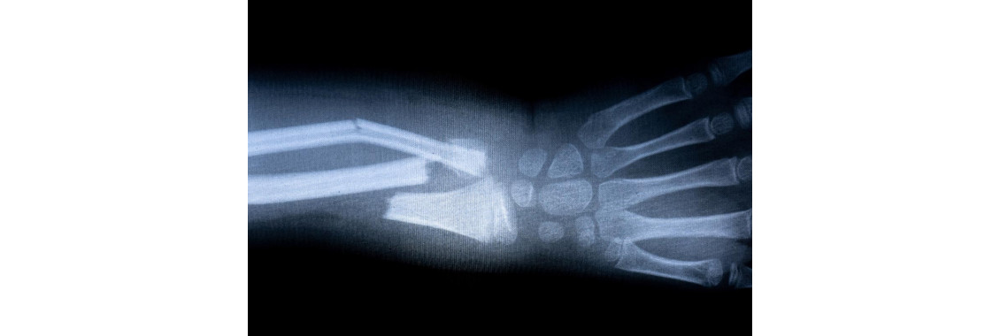 Перелом кости предплечья