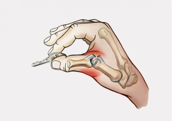 Травма локтевой коллатеральной связки большого пальца