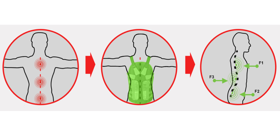 Ортез TLSO образует 3-точечное распределение усилий