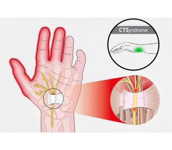 Система запястных туннелей - CTSyndrome
