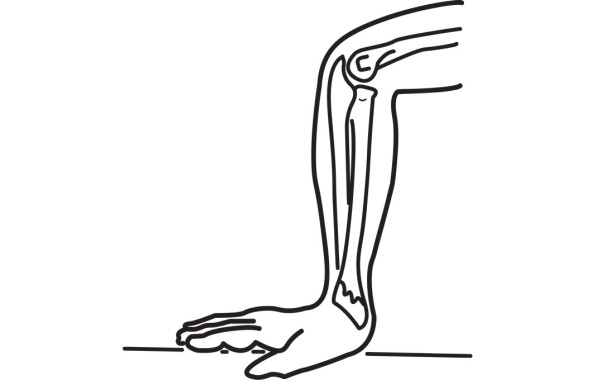 Перелом запястья