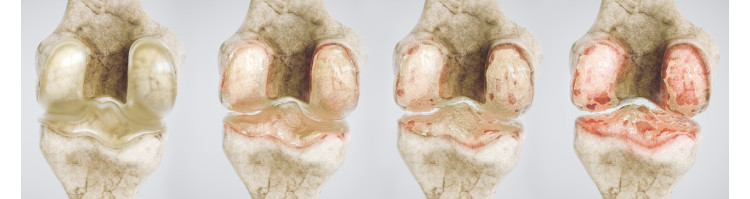 Остеоартроз коленного сустава