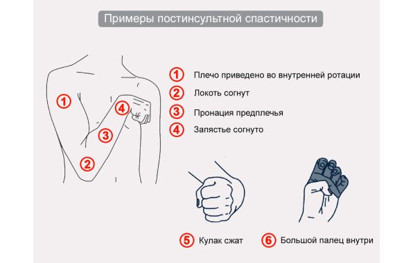 Постинсультная спастичность