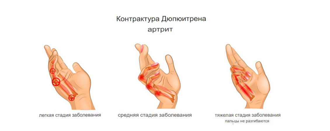 Болезнь Дюпюитрена